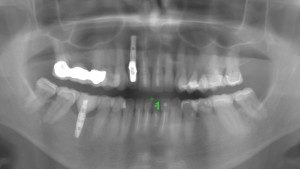 Pre-Op Panoramic X-Ray