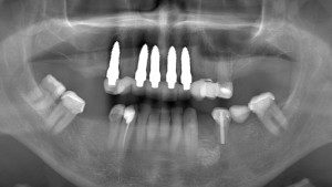 Panoramic X-Ray PostOp