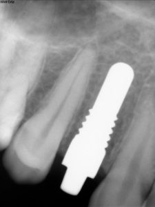 Periapical X-ray