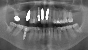 Post Op Panoramic X-Ray