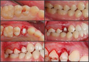 Replacing Maxillary Right Premolar with CeraRoot 14