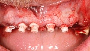 SDS Zirconia Implants Placed
