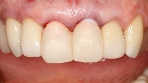 Temp Crowns on Immediate Implants